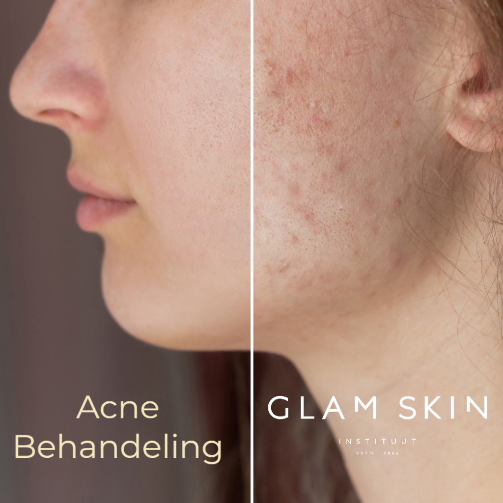 Acne behandeling in Enschede bij Glam Skin Institute