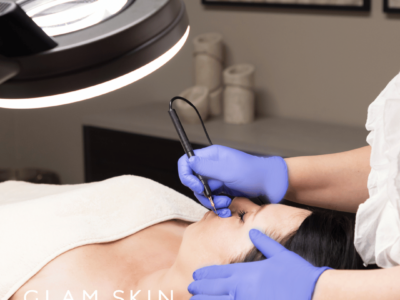 Couperose Behandeling Enschede